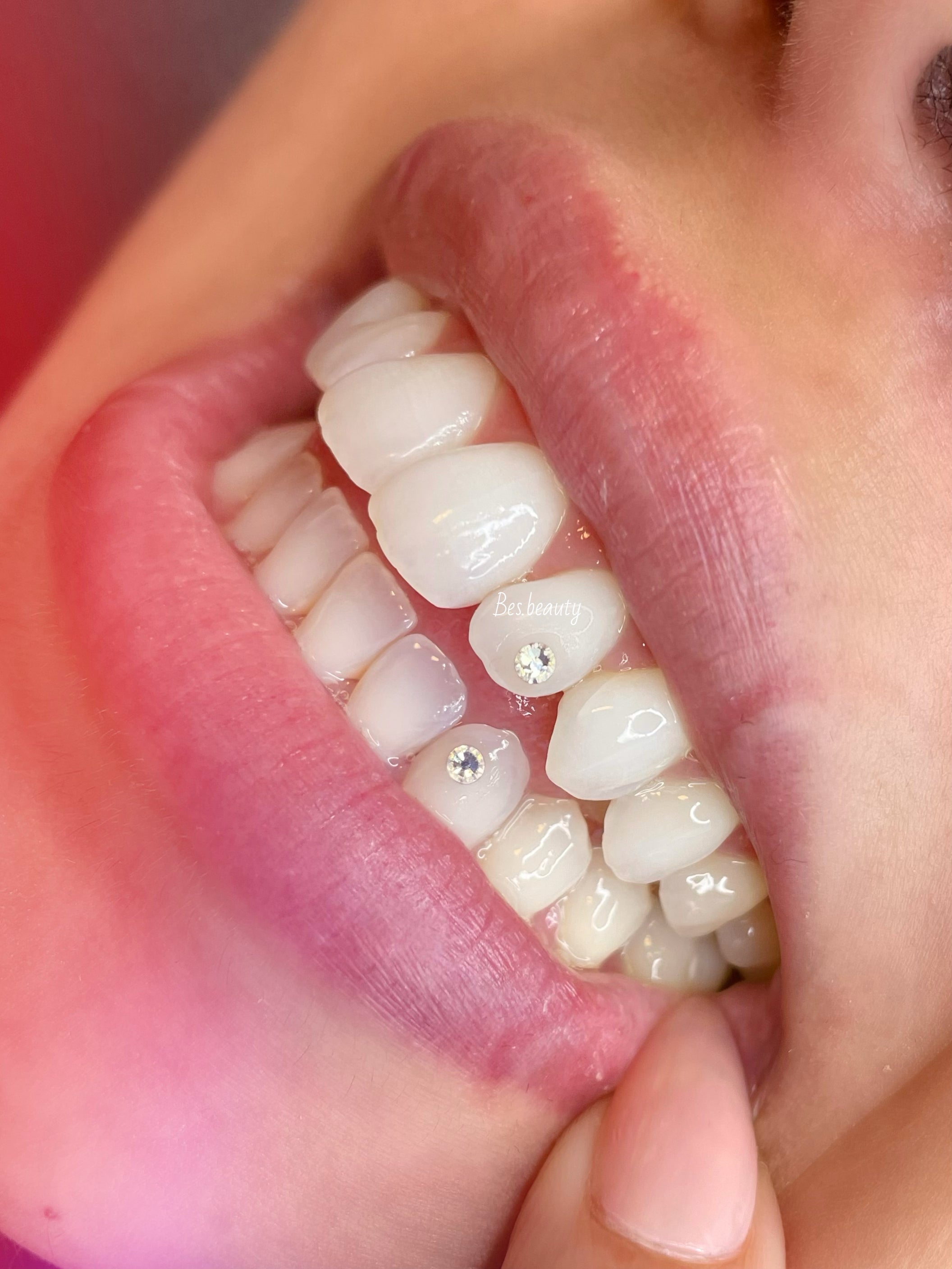 Teeth Whitening + Tooth Gem 💎 - Belle Beauty Academy